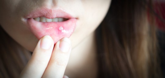 口内炎、なかでも血豆のようなものができたときの対処法は？