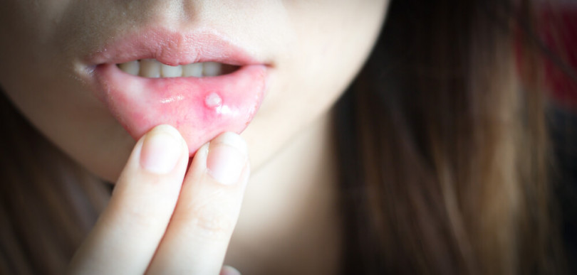 口内炎 なかでも血豆のようなものができたときの対処法は お口のケアで生涯健康に Oral First オーラルファースト